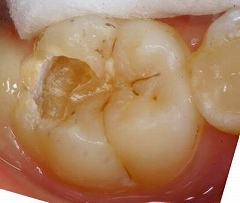 虫歯による歯の痛み