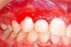 歯周病（歯肉炎を含む）による歯茎のはれ・痛み